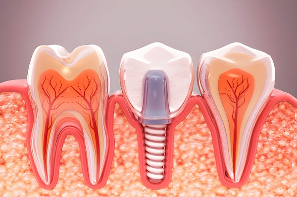 Best Dental Implants Clinic in Bandra